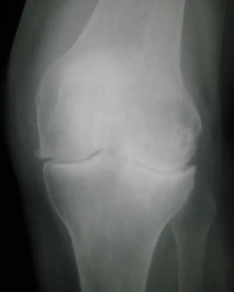 Radiografia de joelho com artrose, mostrando redução do espaço articular e osteófitos — imagem ilustrativa