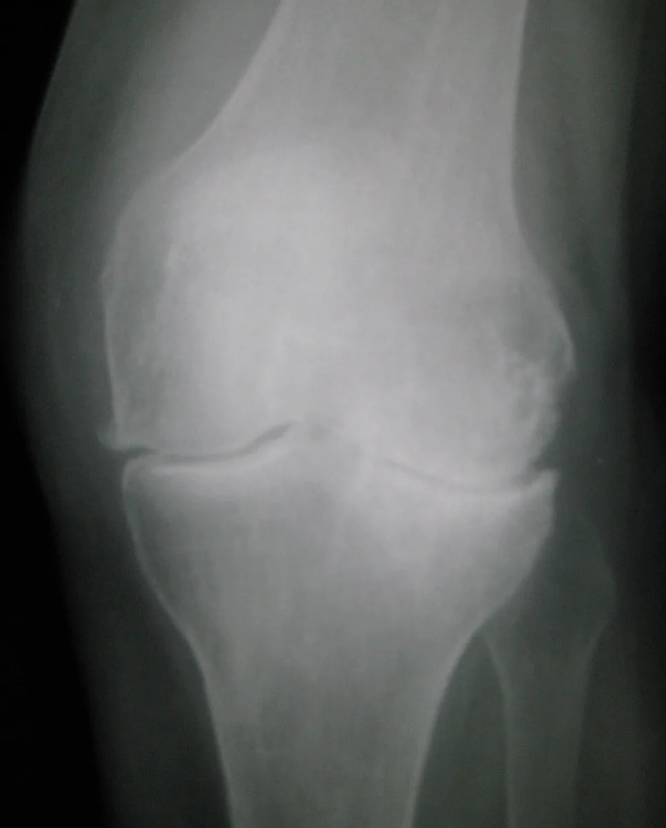 Radiografia de joelho com artrose, mostrando redução do espaço articular e osteófitos — imagem ilustrativa