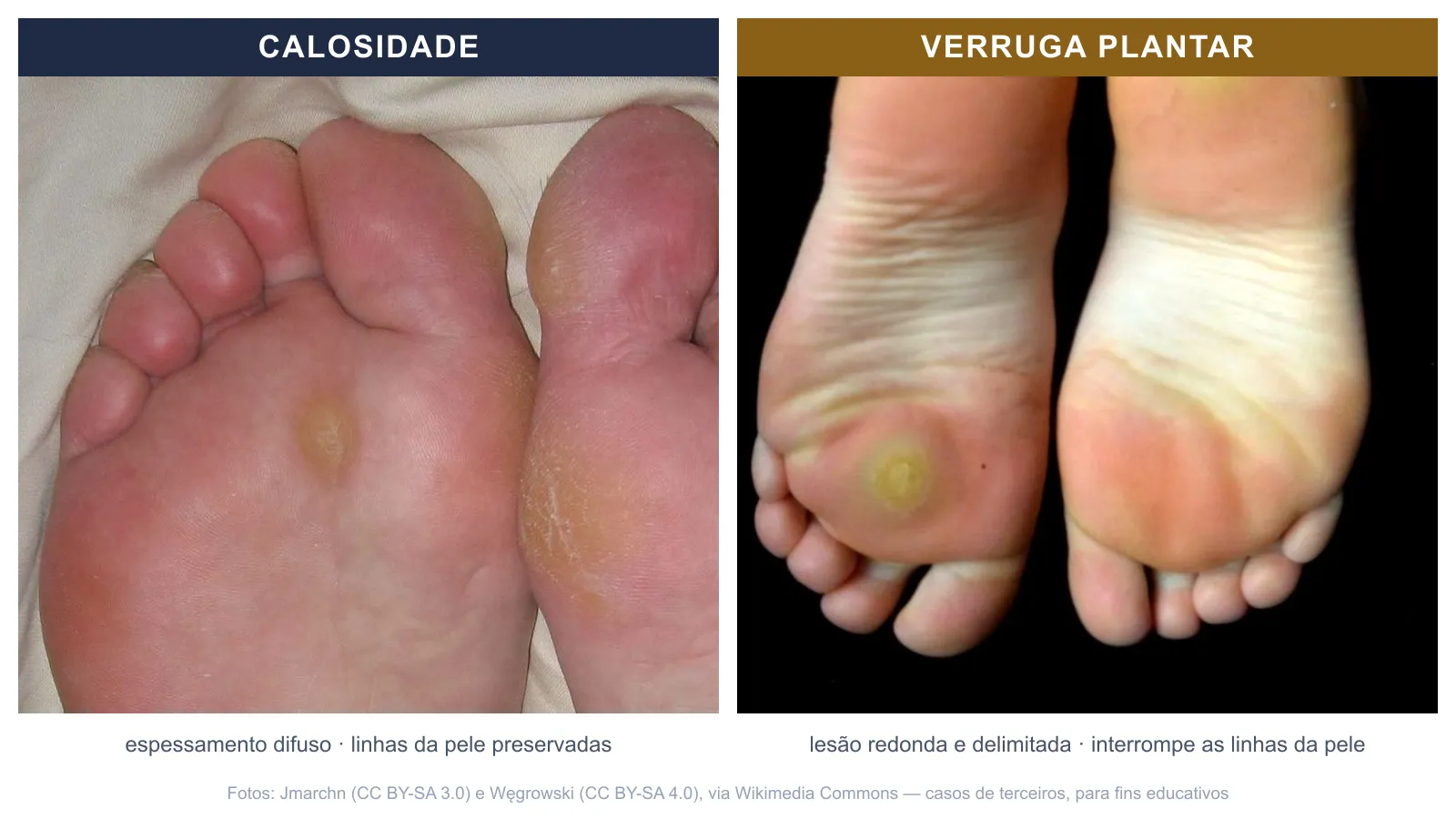 Comparação lado a lado entre calosidade plantar (espessamento difuso da pele) e verruga plantar (lesão redonda e delimitada)