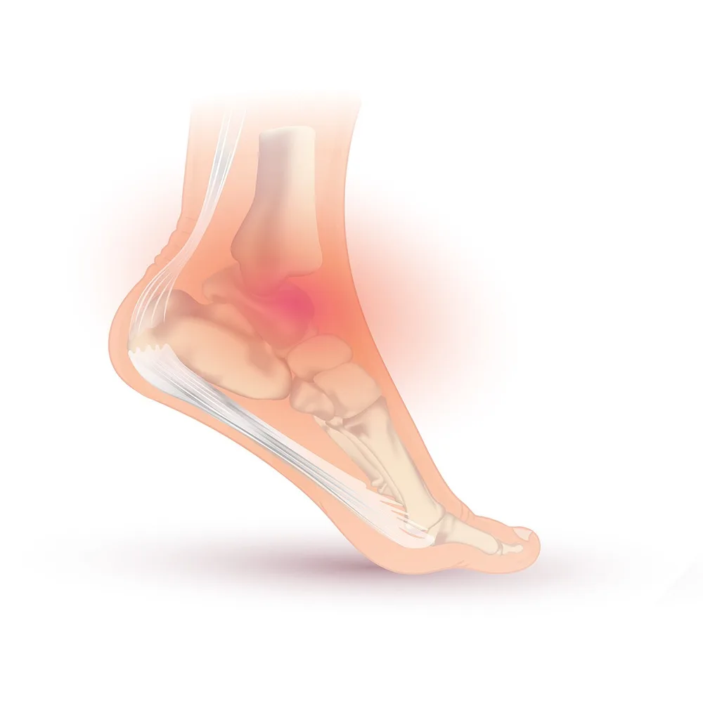 Ilustração de entorse de tornozelo: o pé torcendo para dentro (inversão), com a região do ligamento lateral inflamada