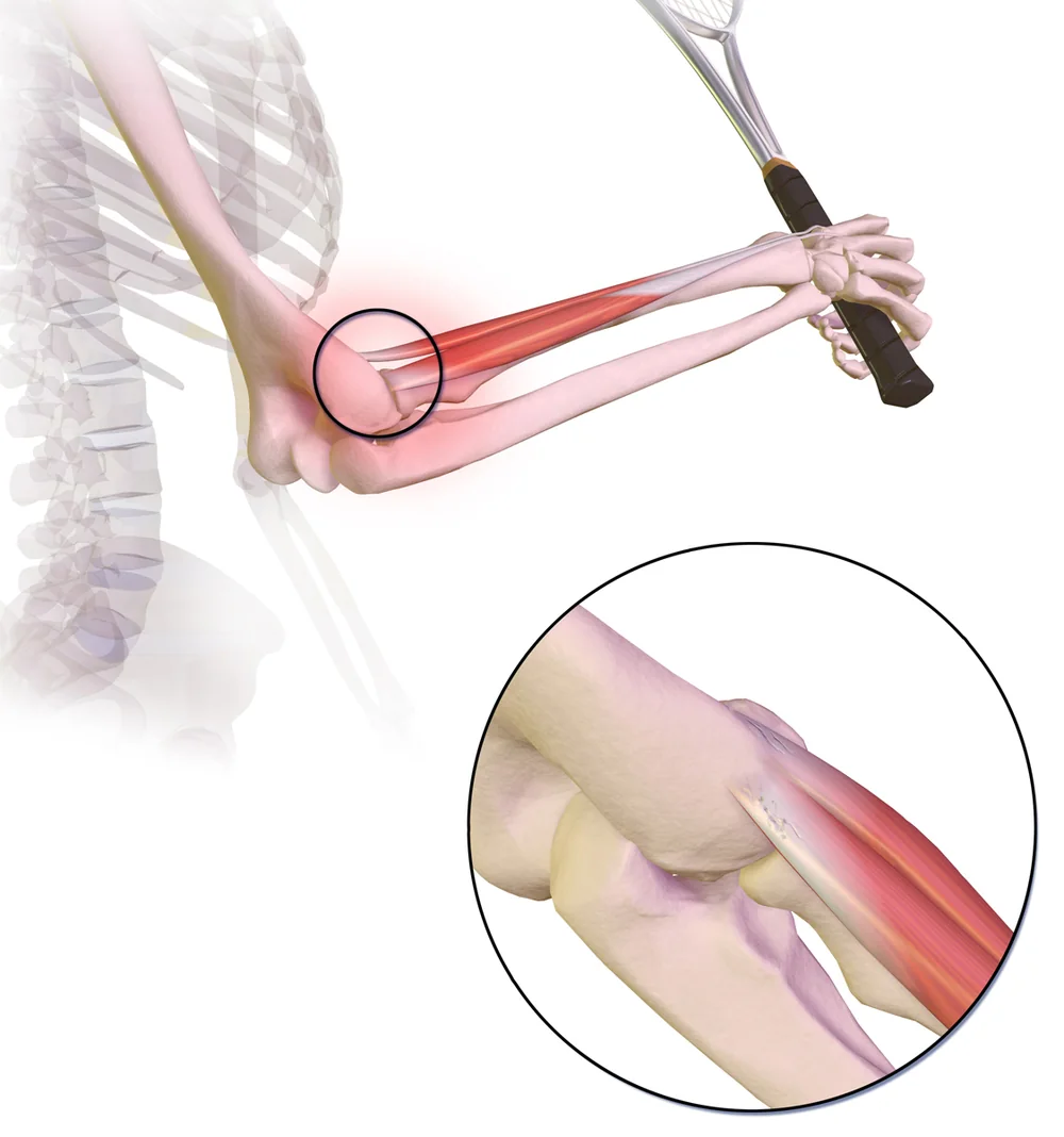 Ilustração médica do cotovelo mostrando a origem dos tendões extensores no epicôndilo lateral, região acometida na epicondilite