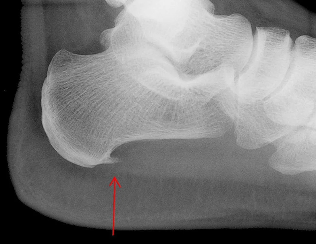 Radiografia lateral do calcanhar com esporão de calcâneo apontado por uma seta vermelha