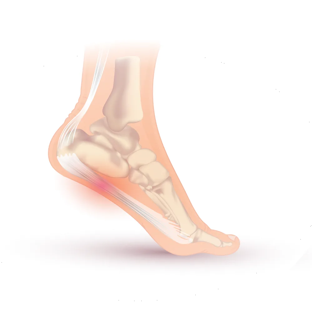 Ilustração médica do pé destacando a fáscia plantar inflamada na região do calcanhar