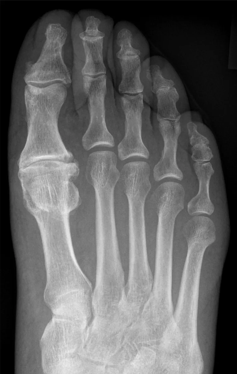 Radiografia do antepé mostrando hálux rígido, com estreitamento do espaço da articulação do dedão