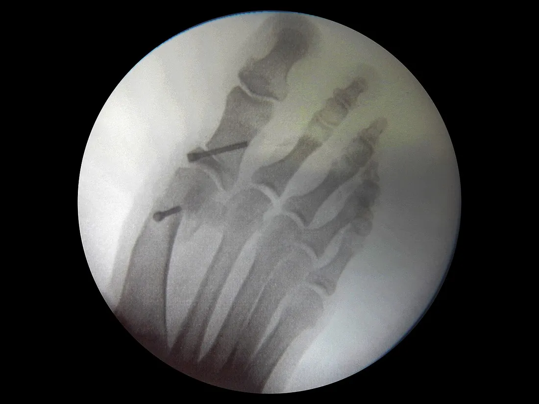 Radiografia de pé com hálux valgo, mostrando o desvio do dedão e a saliência óssea na base do primeiro metatarso