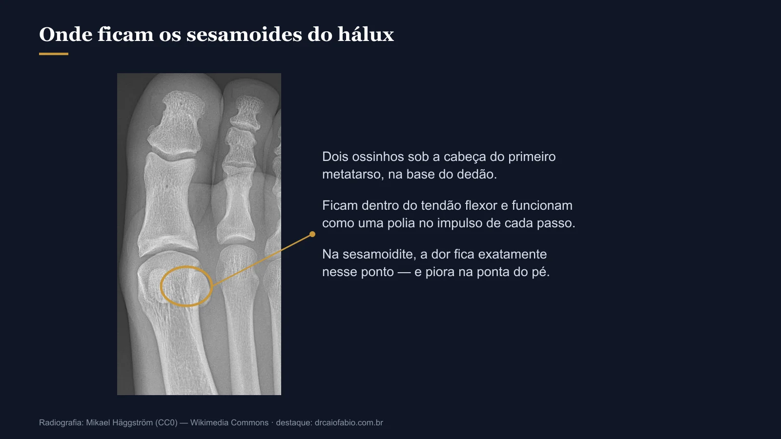 Radiografia do antepé com destaque para a região dos sesamoides, sob a cabeça do primeiro metatarso