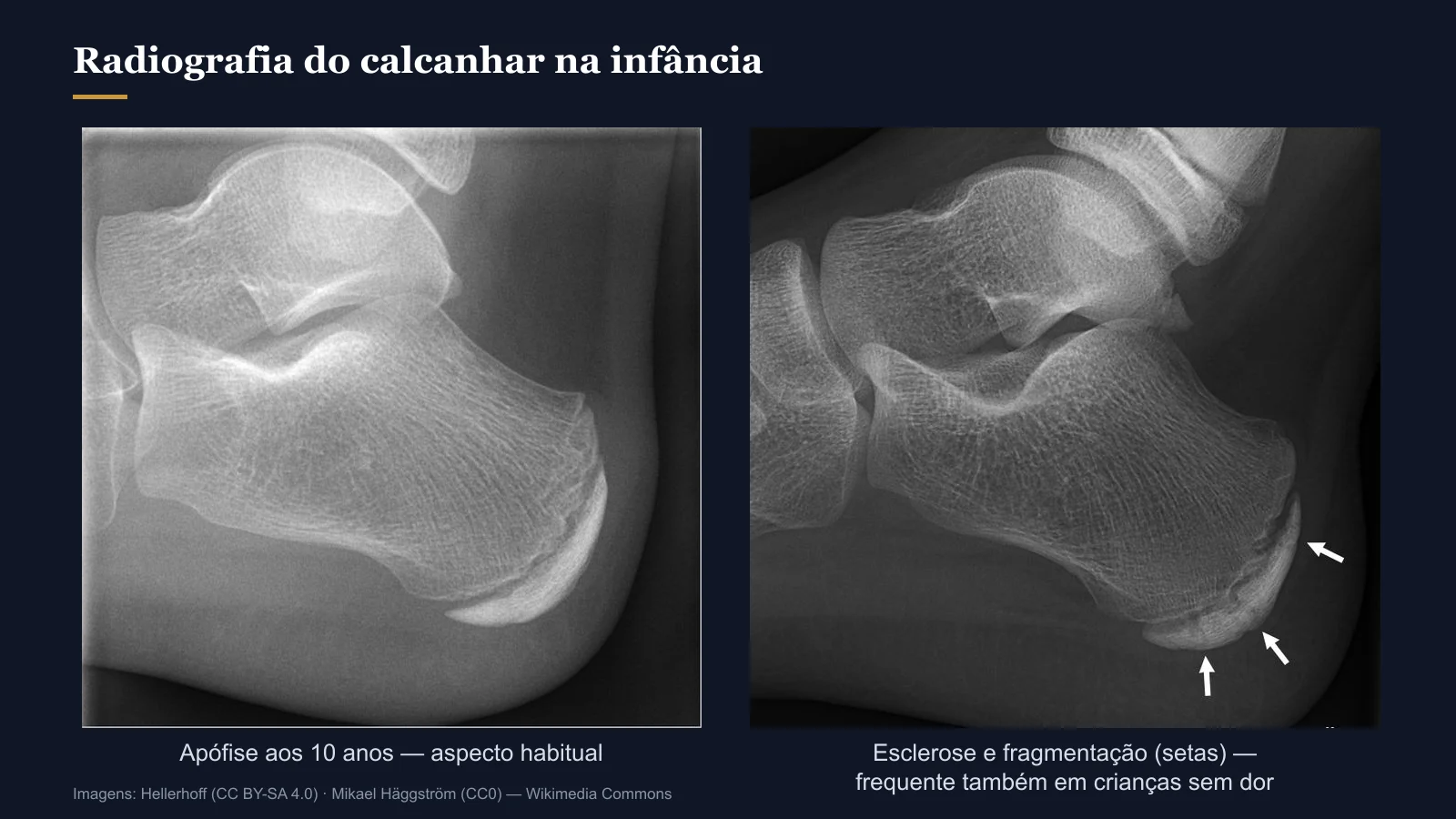 Radiografias laterais do calcanhar infantil mostrando a apófise do calcâneo com aspecto habitual e com esclerose e fragmentação