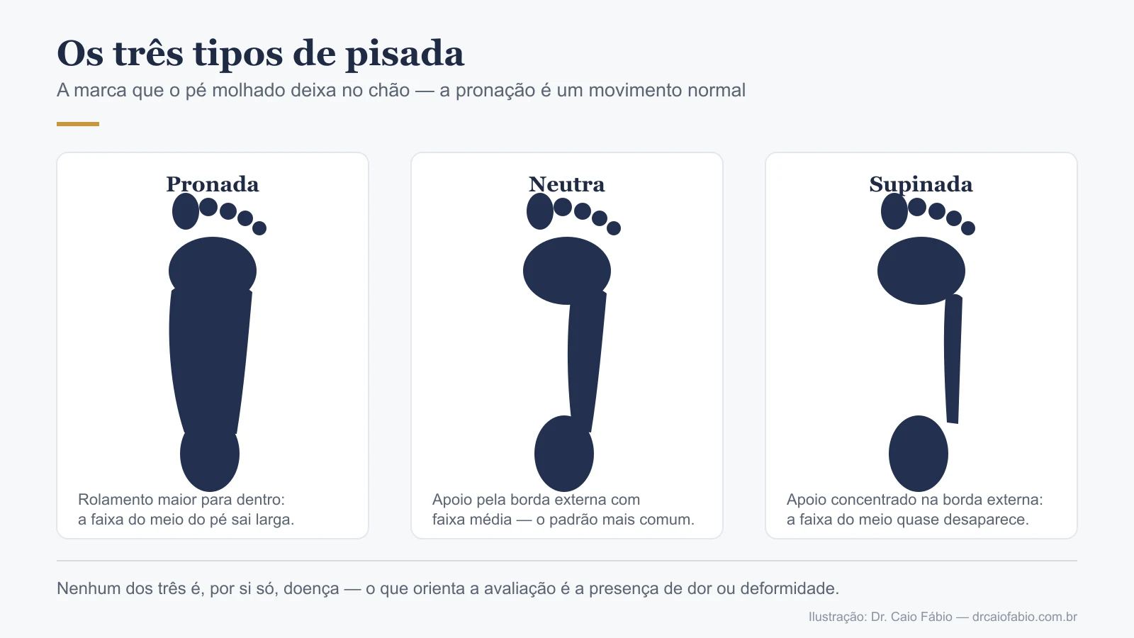 Infográfico com as marcas do teste da pisada molhada nos três tipos de pisada: pronada, neutra e supinada