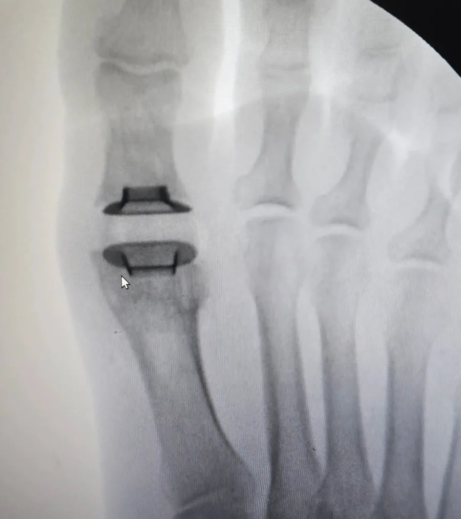 Radiografia intraoperatória de prótese na primeira articulação metatarsofalângica, caso operado pelo Dr. Caio Fábio