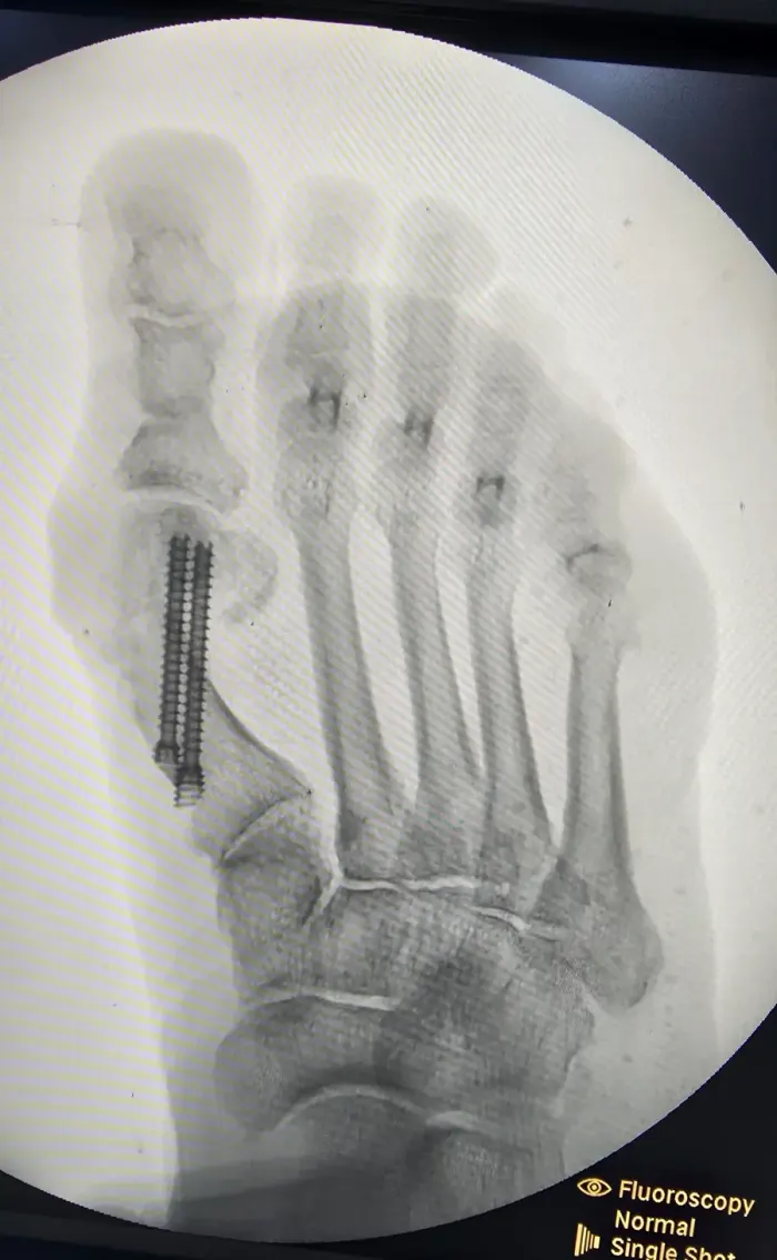 Imagem de fluoroscopia durante a cirurgia percutânea de joanete, mostrando a fixação com parafuso