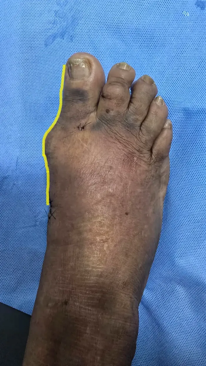 Pé no pós-operatório da cirurgia minimamente invasiva de joanete, com alinhamento corrigido e incisões milimétricas