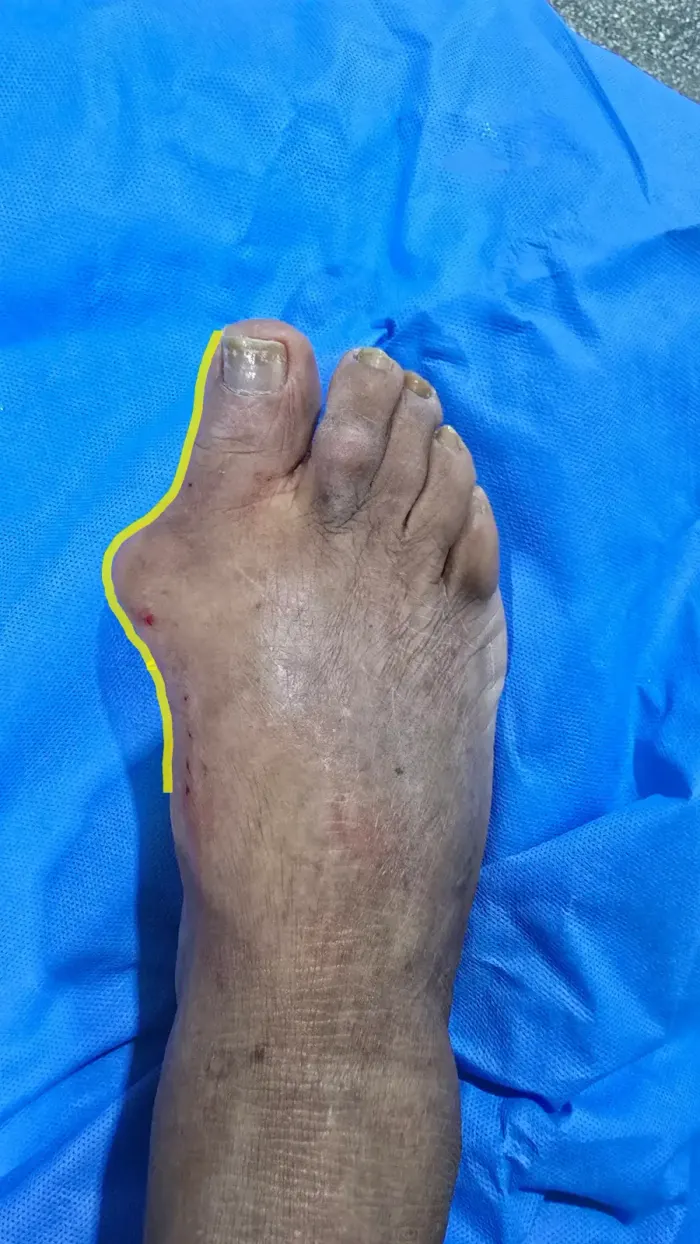 Pé com joanete (hálux valgo) antes da cirurgia, com traçado indicando o desvio do dedão