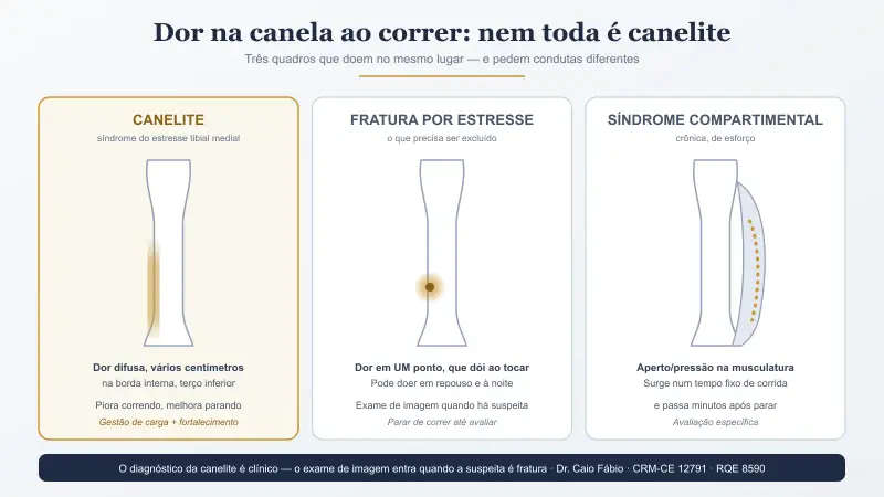 Corredor parado ao ar livre segurando com as duas mãos a face interna da canela, local típico da dor na canelite — imagem ilustrativa