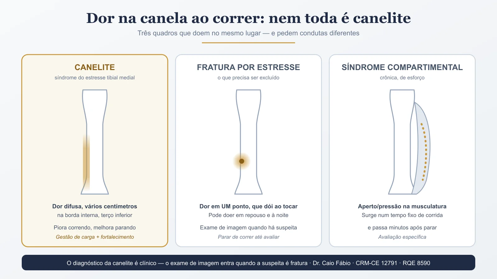 Corredor parado ao ar livre segurando com as duas mãos a face interna da canela, local típico da dor na canelite — imagem ilustrativa