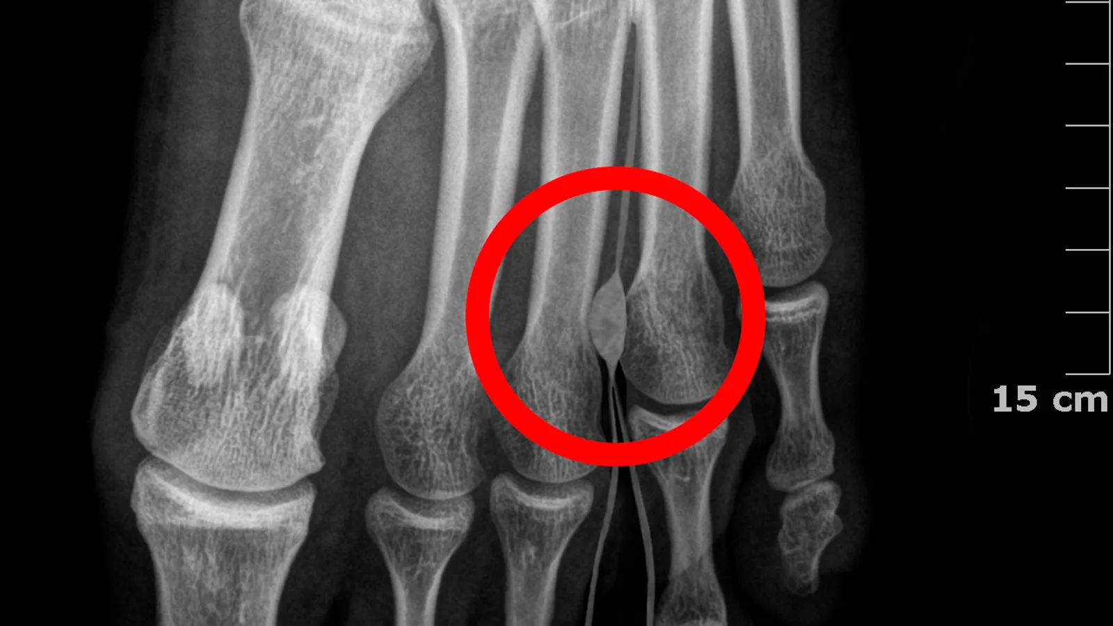 Radiografia do pé com o neuroma de Morton ilustrado entre o terceiro e o quarto metatarsos, destacado por um círculo