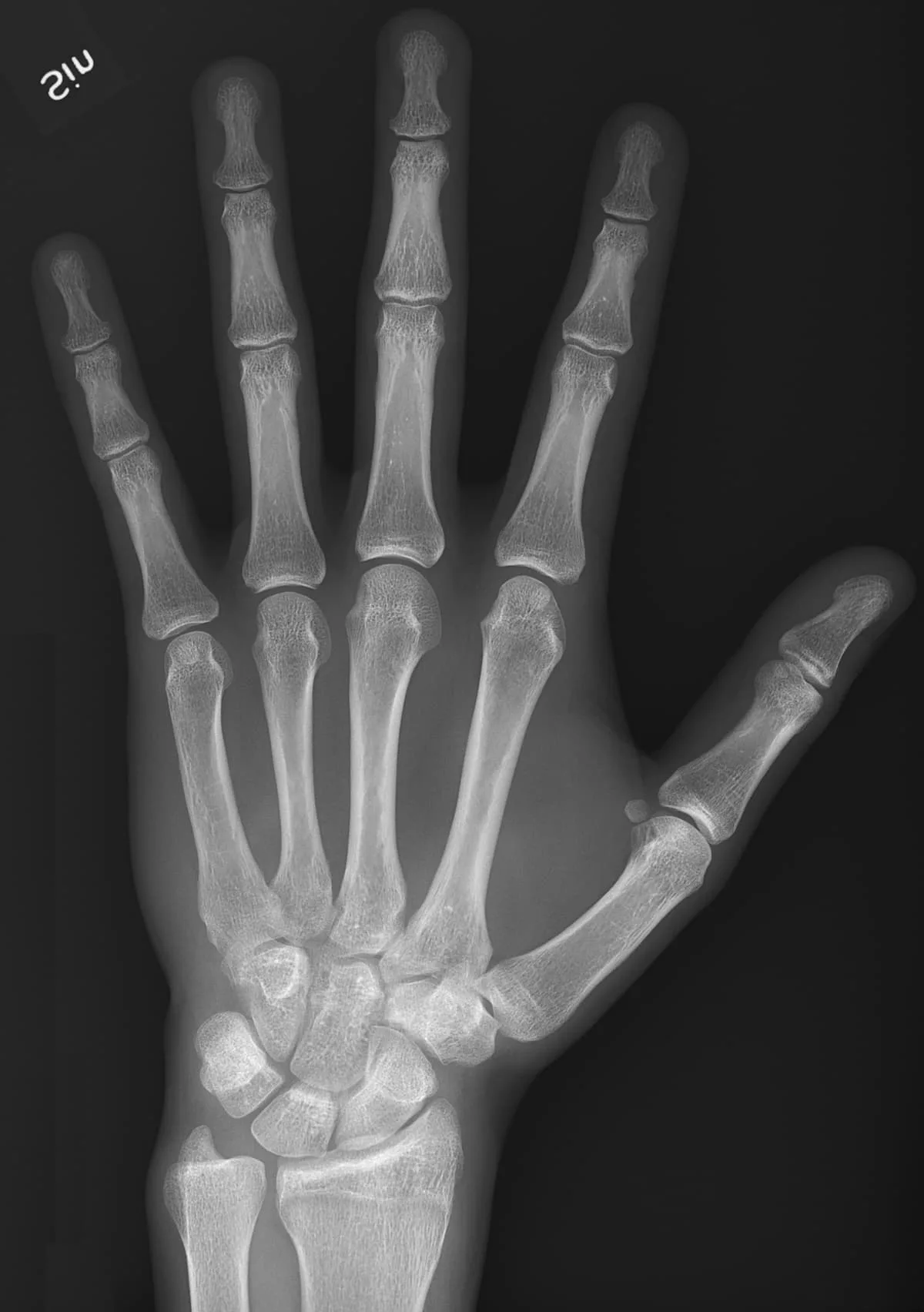 Radiografia de mão em projeção dorsoplantar — imagem ilustrativa